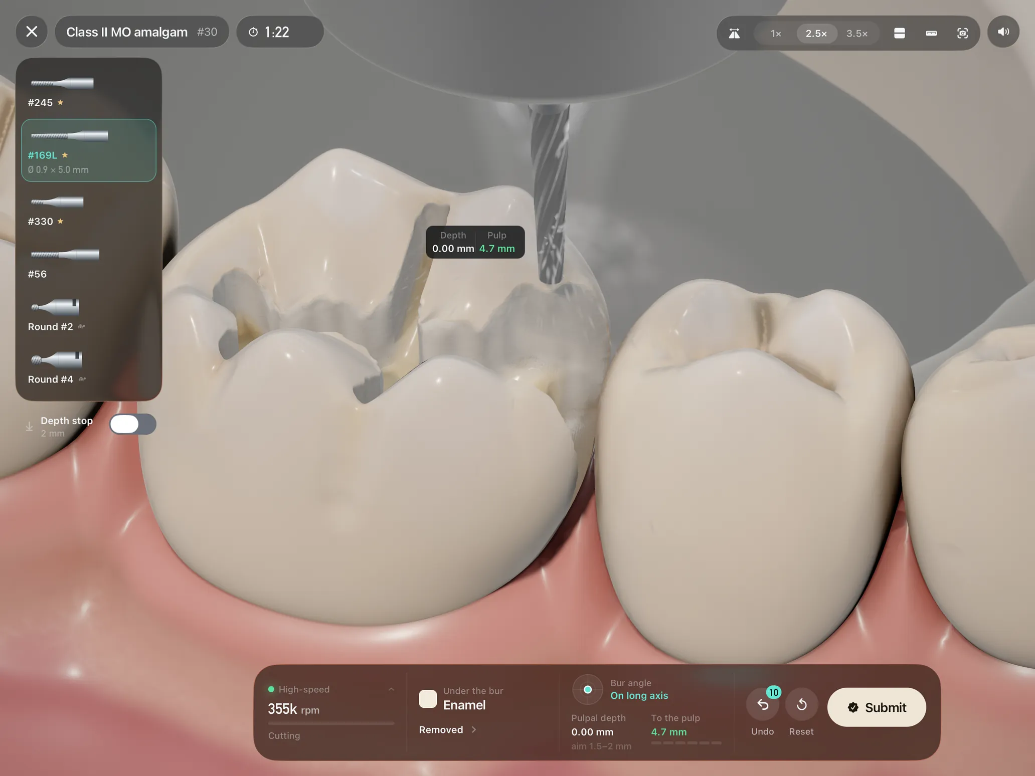 Handpiece on iPad: a Class II MO amalgam preparation on tooth 30 at 2.5x loupes, the #169L bur cutting with water spray, a live readout of depth and 4.7 mm to the pulp, the bur tray, and Submit.