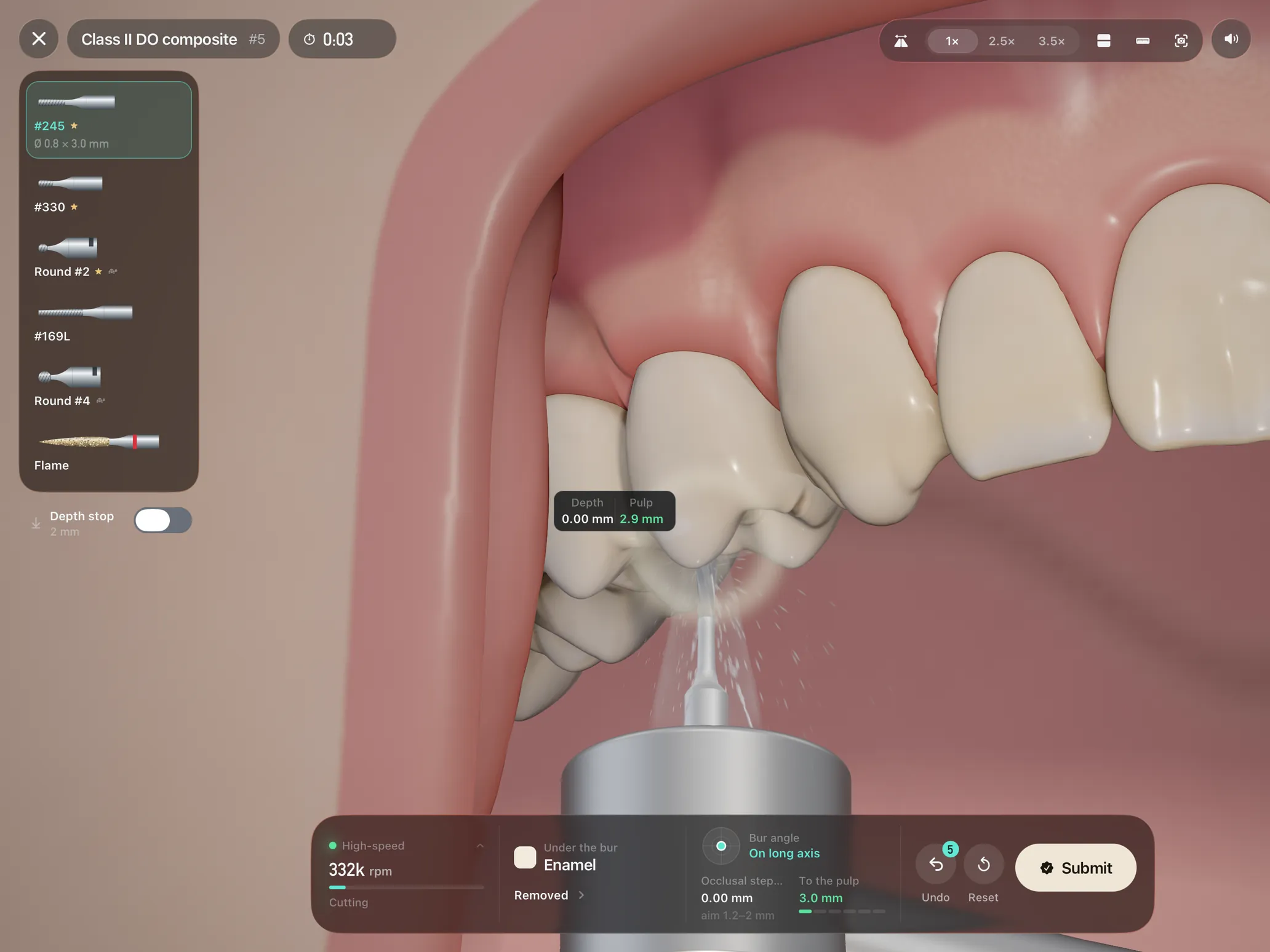 Handpiece on iPad: a Class II DO composite on tooth 5 in the phantom head, the handpiece spraying water under the maxillary arch, with lips and cheeks retracted and a 0:03 clock.