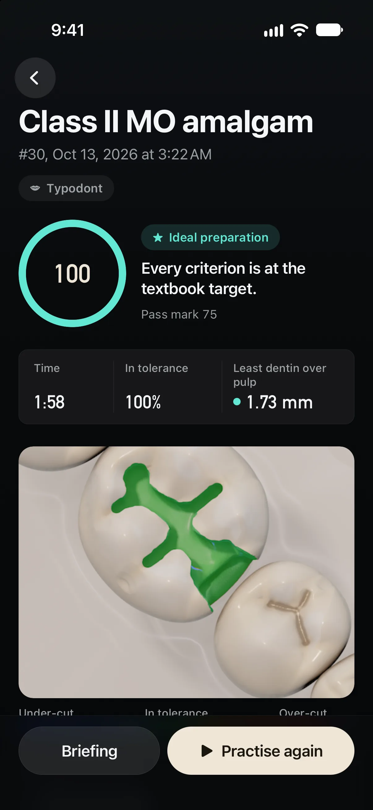 Graded result on iPhone for a Class II MO amalgam preparation on tooth 30 in Handpiece: score 100, ideal preparation, pass mark 75, 100% in tolerance and 1.73 mm of dentin over the pulp.